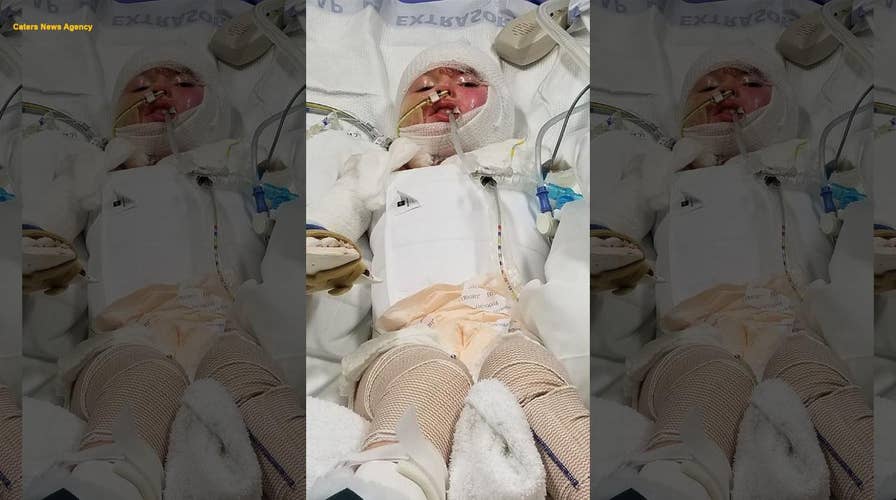 Little girl sustains horrific burns across 68 percent of her body after candle lit sofa on fire