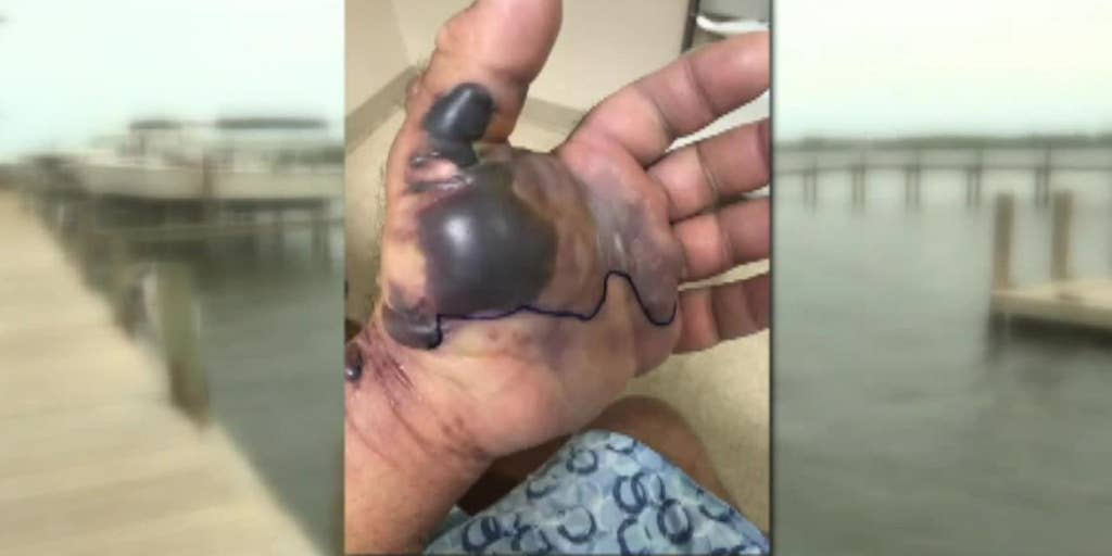 Is Flesh Eating Bacteria Heading To A Beach Near You Fox News