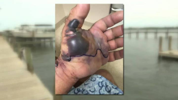 Fisherman recovering from ‘flesh-eating’ bacteria after getting struck with fish hook