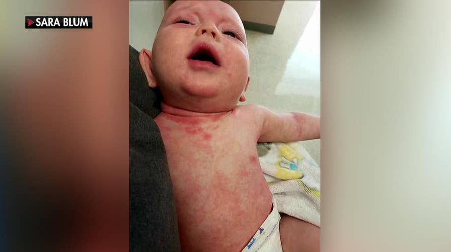 Mother shares heartbreaking photos of baby son with measles, urges people to get vaccinated
