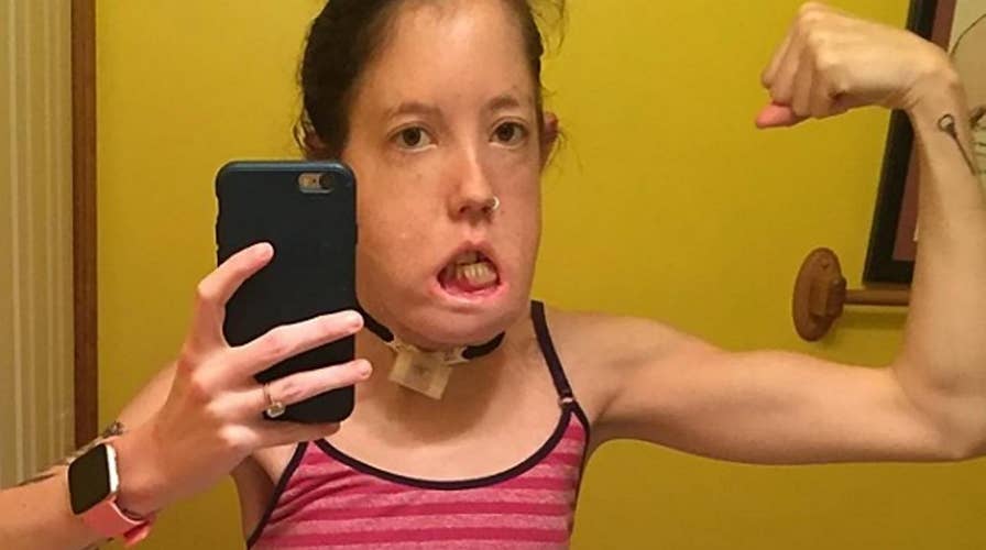 Woman born with rare cyst condition defies odds, becomes disability rights advocate