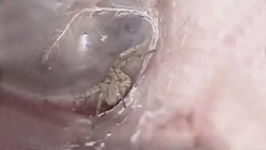 Image result for Doctor finds spider building a nest inside man's ear