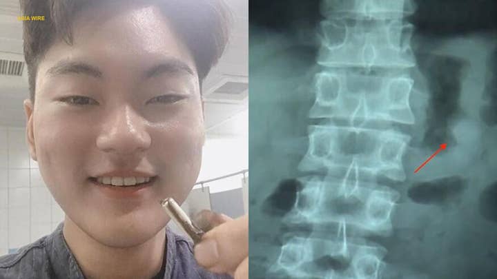 Accidentally swallowed AirPod amazingly works after passing through man’s digestive system