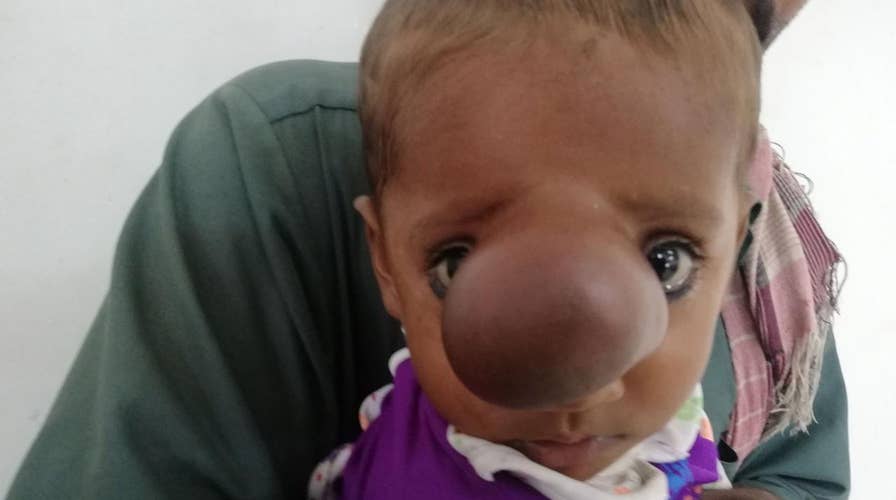 Infant born with brain sticking out of nose
