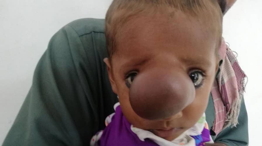 Infant born with brain sticking out of nose