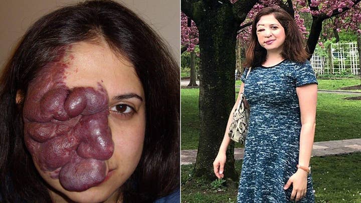 Life changing surgeries help nursing student remove ‘port wine birthmark’