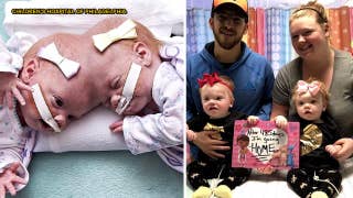 Conjoined twins attached at the head doing well after separation surgery - Fox News