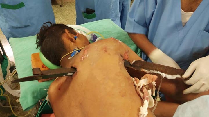 A driver in India miraculously survives being impaled by a 2.5-foot-long iron spike