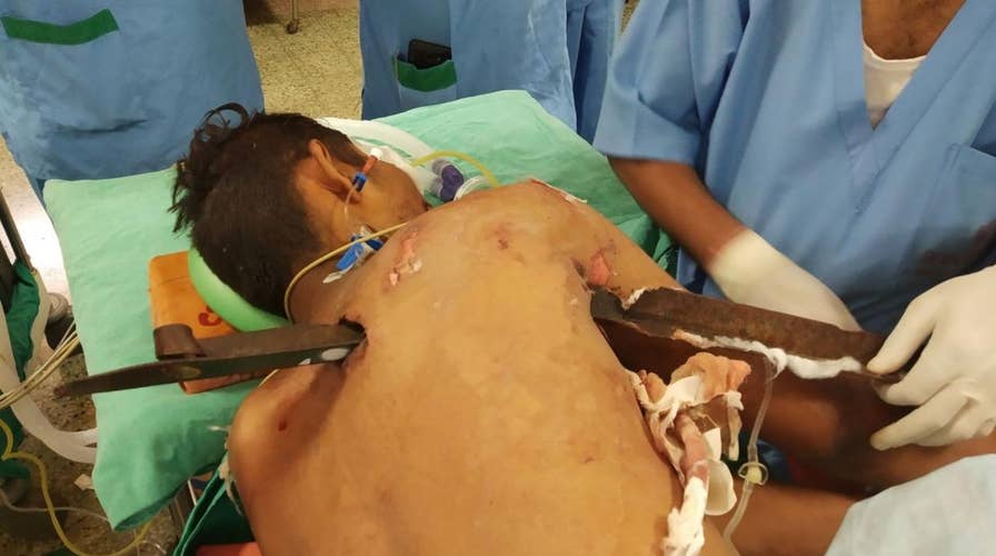 A driver in India miraculously survives being impaled by a 2.5-foot-long iron spike