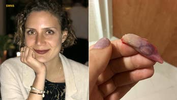 'Slug'-sized growths removed from woman's nose after complaints of breathing issues