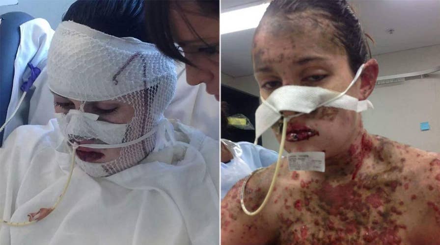 Woman ‘burnt from inside out’ after severe reaction to medication pregnant with 'miracle' baby