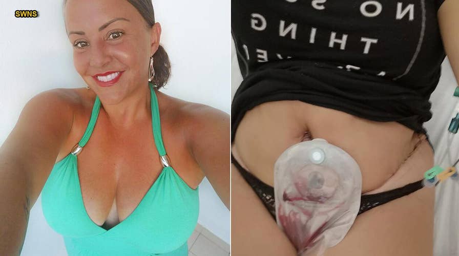 Cheap 'Mommy Makeover' nearly killed U.K. woman