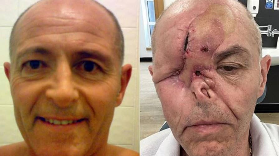 Cancer causes dad to lose eye, but not sense of humor
