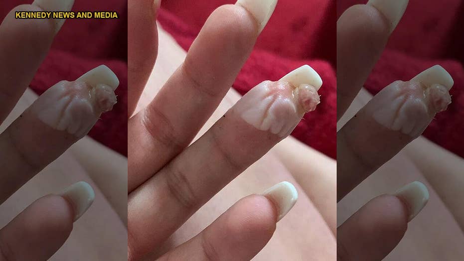 Woman Claims Botched Acrylic Nail Job Nearly Cost Her A Finger I Ll Never Get My Nails Done Again Fox News