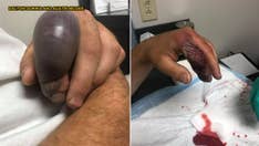 Tennessee man's finger balloons, pops, sheds skin in gory pics after 'freak' rattlesnake bite