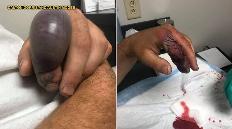 Man's finger balloons after 'freak' rattlesnake bite