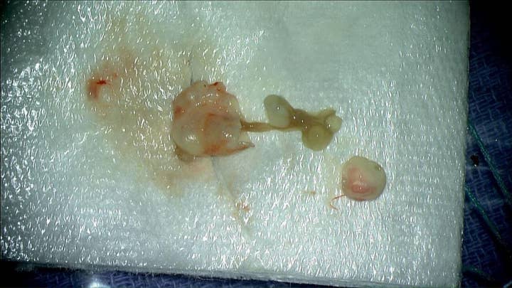 New York doctors at Mount Sinai are shocked when they find a baby tapeworm in a woman’s brain