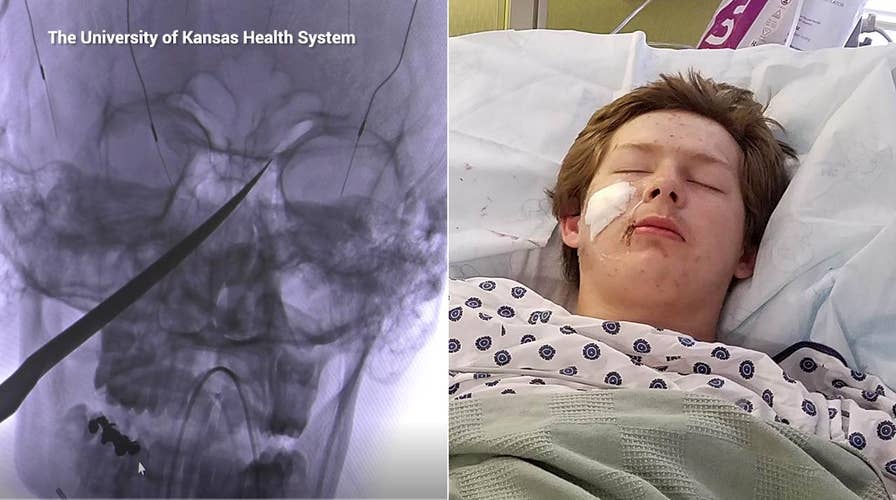 Surgeons remove 10-inch knife from teen's skull