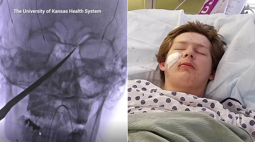 Surgeons remove 10-inch knife from teen's skull