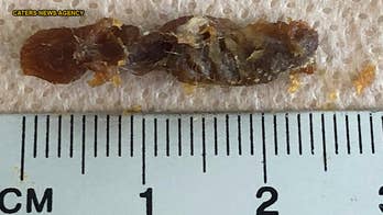 Earwax clump clogging entire ear canal removed from patient: 'Look at that!'