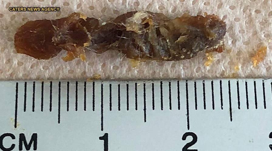 Earwax clump clogging entire ear canal removed from patient