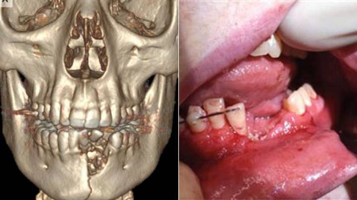 Vape pen explodes shattering teen’s teeth