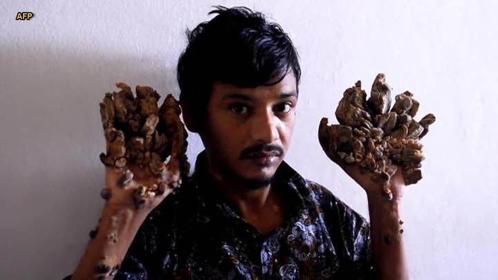 'Tree Man' begs for hands to be amputated to relieve pain: Report