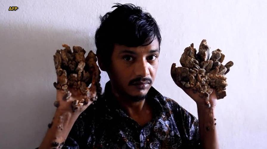 'Tree Man' begs for hands to be amputated to relieve pain: Report