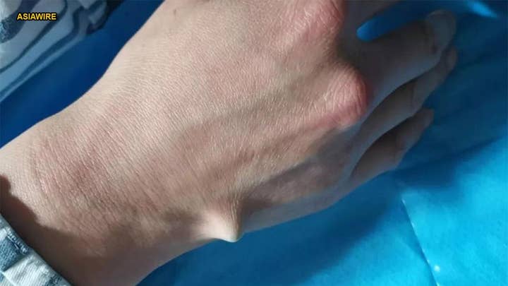 Man needs surgery to remove chopstick from hand after attempting trick to open beer bottle