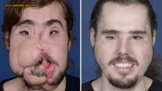 How a face transplant helped suicide survivor get his life back