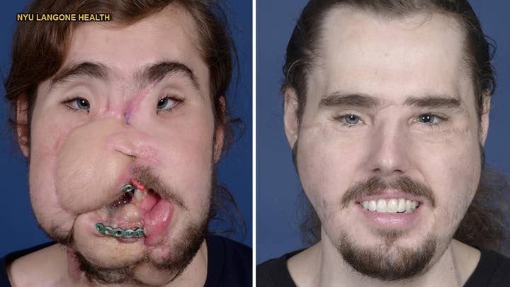 Face transplant helps suicide victim get his life back