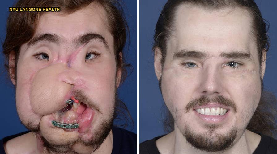 Face transplant helps suicide victim get his life back