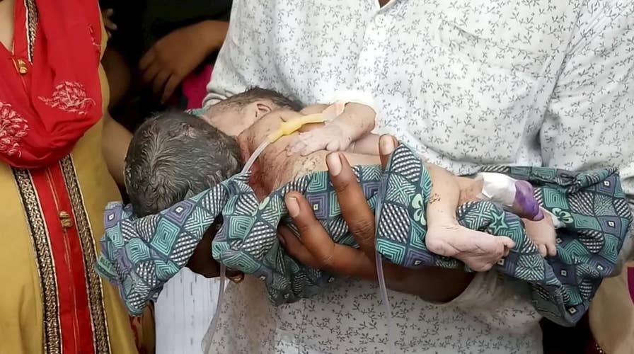 Conjoined twins born sharing same heart in India: 'Separation is almost impossible'