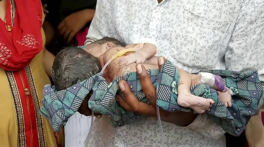 Conjoined twins born sharing same heart in India: 'Separation is almost impossible'
