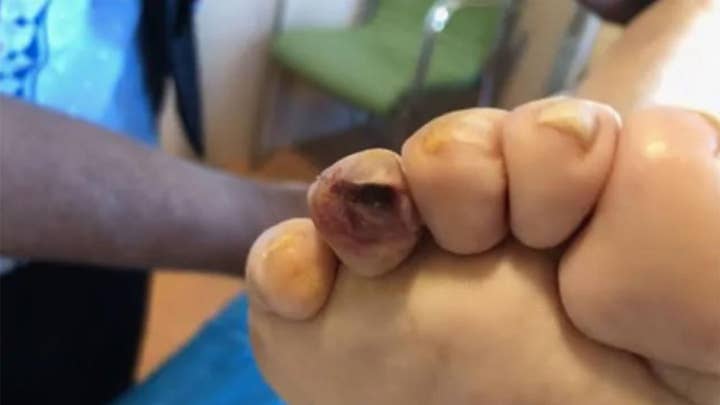 Woman had maggots in foot wound after care center left it untreated for months