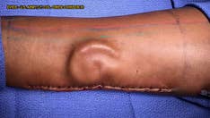 Soldier who lost ear in accident gets another after doctors 'grow' it on her arm