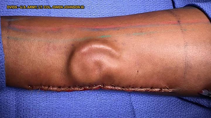 Doctors 'grow' soldier's replacement ear on her arm