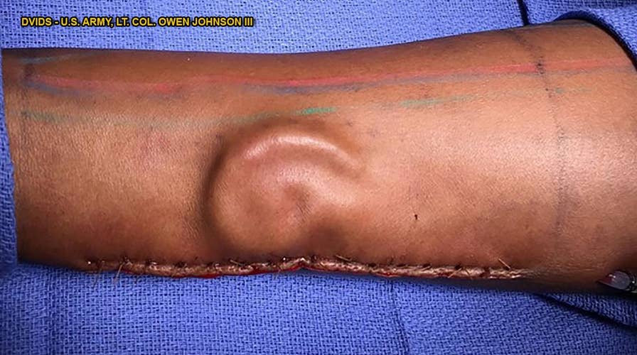 Doctors 'grow' soldier's replacement ear on her arm