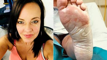Mom suffers severe foot burns after stepping on sand under 'cold' disposable barbecue