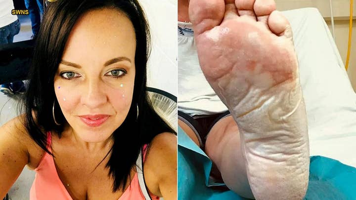 GRAPHIC PHOTOS: Mom suffers severe foot burns after stepping on sand under 'cold' disposable barbecue