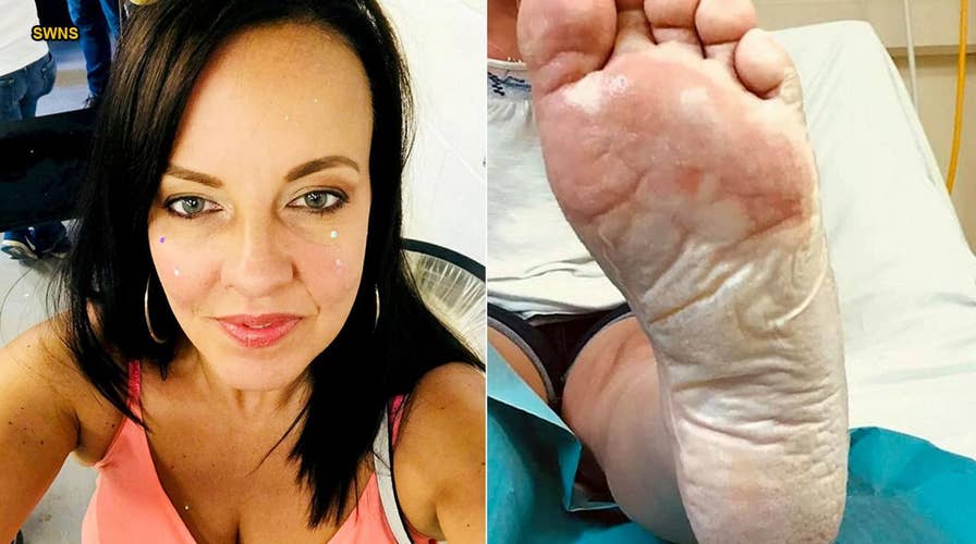 GRAPHIC PHOTOS: Mom suffers severe foot burns after stepping on sand under 'cold' disposable barbecue