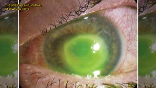 Woman who wore contact lenses while showering, swimming nearly blinded in one eye - Fox News
