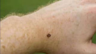 Did the Pentagon's weaponization of ticks lead to the spread of Lyme disease? - Fox News