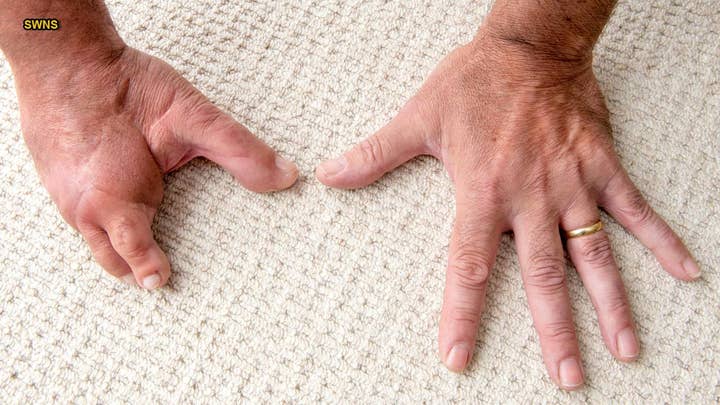 Father gets fingers replaced with toes after losing them in industrial blender accident