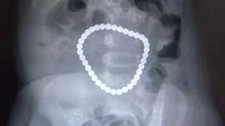 Report: Surgeons remove 36 magnetic balls from toddler's stomach - Fox News