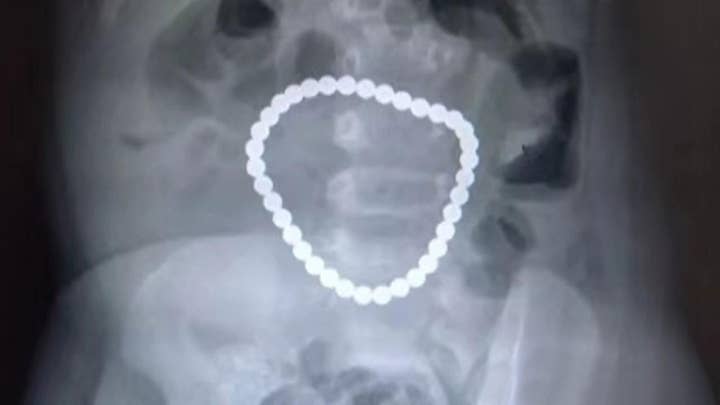 Report: Surgeons remove 36 magnetic balls from toddler's stomach