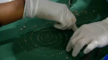 Boy has over 500 'teeth' removed after complaining of pain in jaw