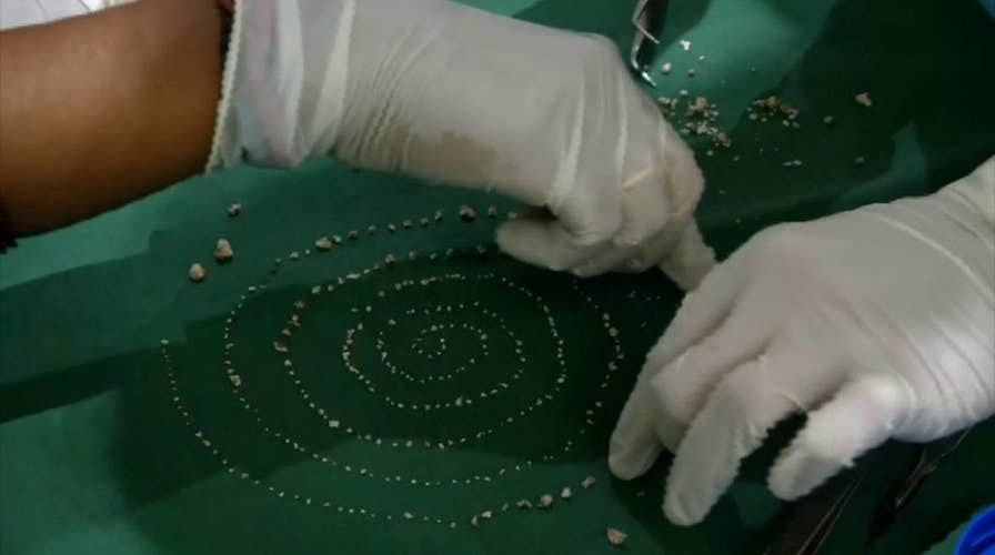 Raw video: Doctors in India remove 526 teeth from a seven-year-old boy’s mouth