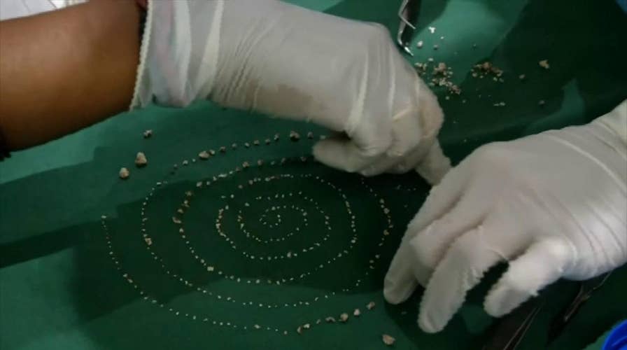 Raw video: Doctors in India remove 526 teeth from a seven-year-old boy’s mouth
