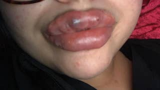 Several women claim botched lip injections caused severe infection  - Fox News